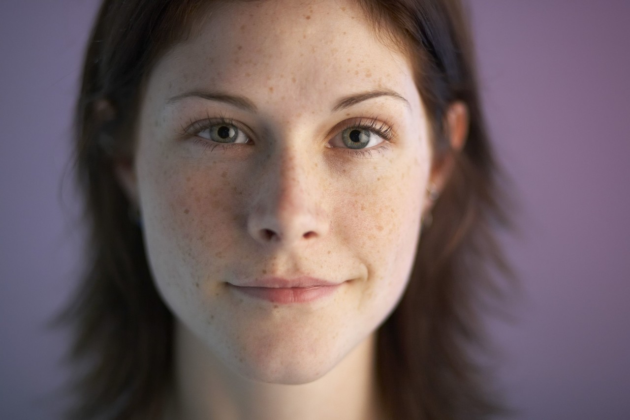 雀斑特别多适合什么方法祛斑,雀斑在什么年龄段祛比较好