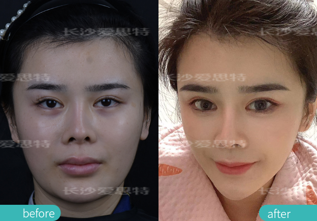 面部雀斑挂哪个科,皮秒嫩肤雀斑