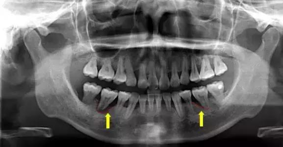 慢性牙周炎的主要优势菌是什么,慢性牙周炎的主要优势致病菌为