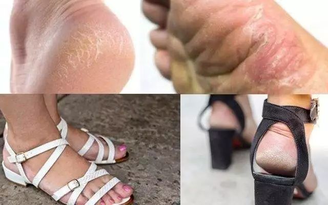 脚气脚臭脚痒的克星用什么,用什么泡脚可以治愈脚气