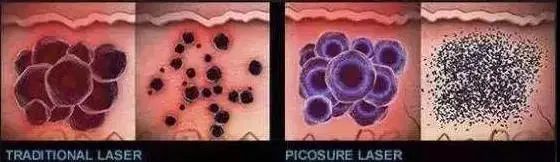 皮秒仪器原理,皮秒祛斑原神