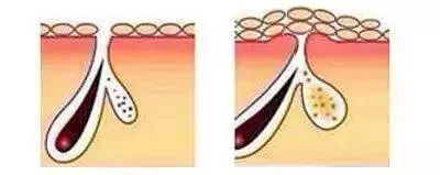 黑头皮肤屏障脆弱容易色素沉着,皮肤黑头闭口暗沉