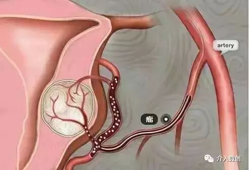 子宫腺肌病保守治疗无效怎么办?