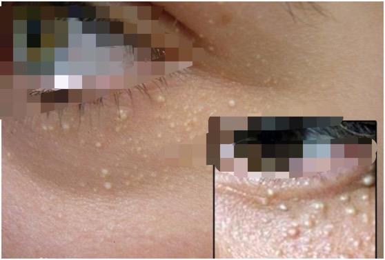 别再用针挑和手抠了，掌握这两步轻松消除脂肪粒，简单还不伤皮肤