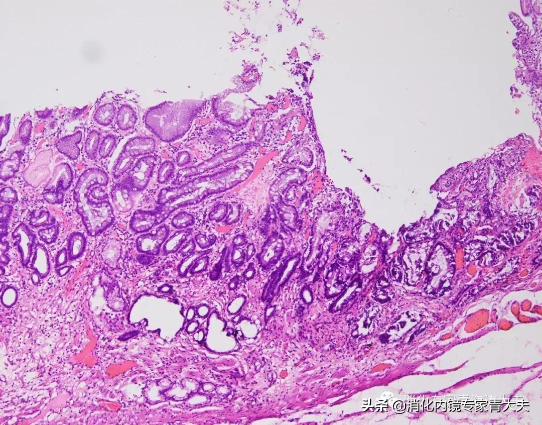 通过科普文章求治的一例胃窦后壁早癌