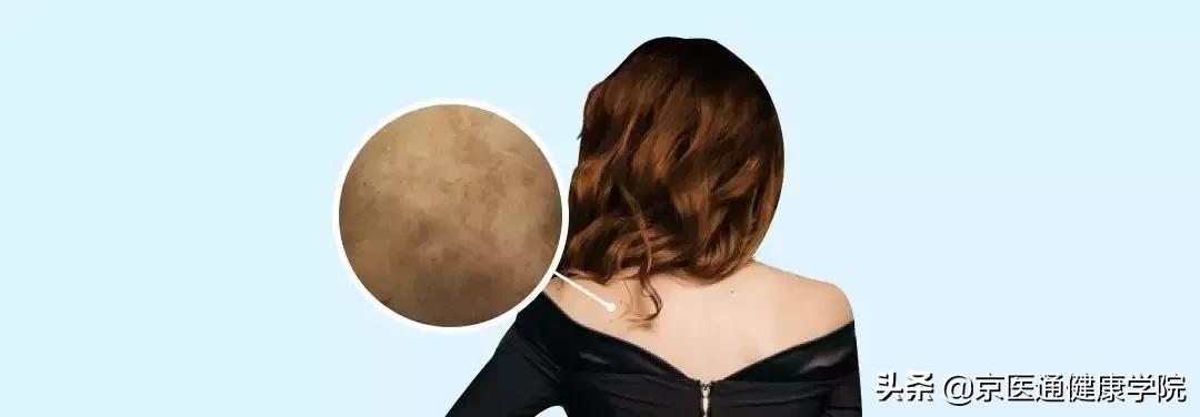 顽固湿疹痘痘,痘痘湿疹肌肤怎么改善