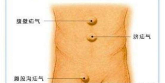 疝气微创手术能彻底根治疝气吗,疝气手术治疗方法哪个最好最安全