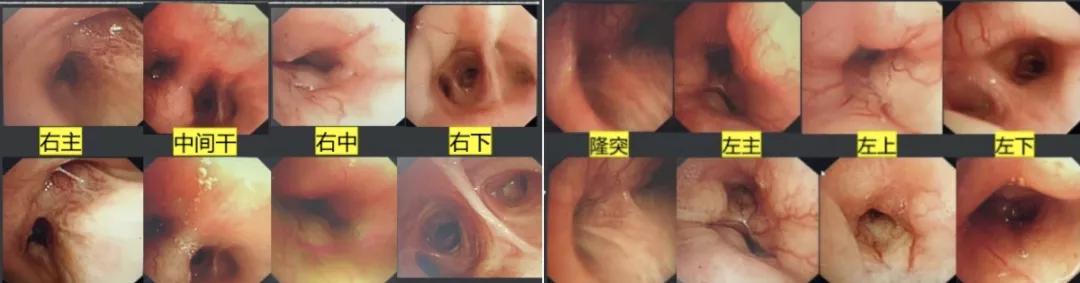 咳嗽咳痰胸腔积液10月余治疗无效，艰难追踪得出哪些教训？（上）