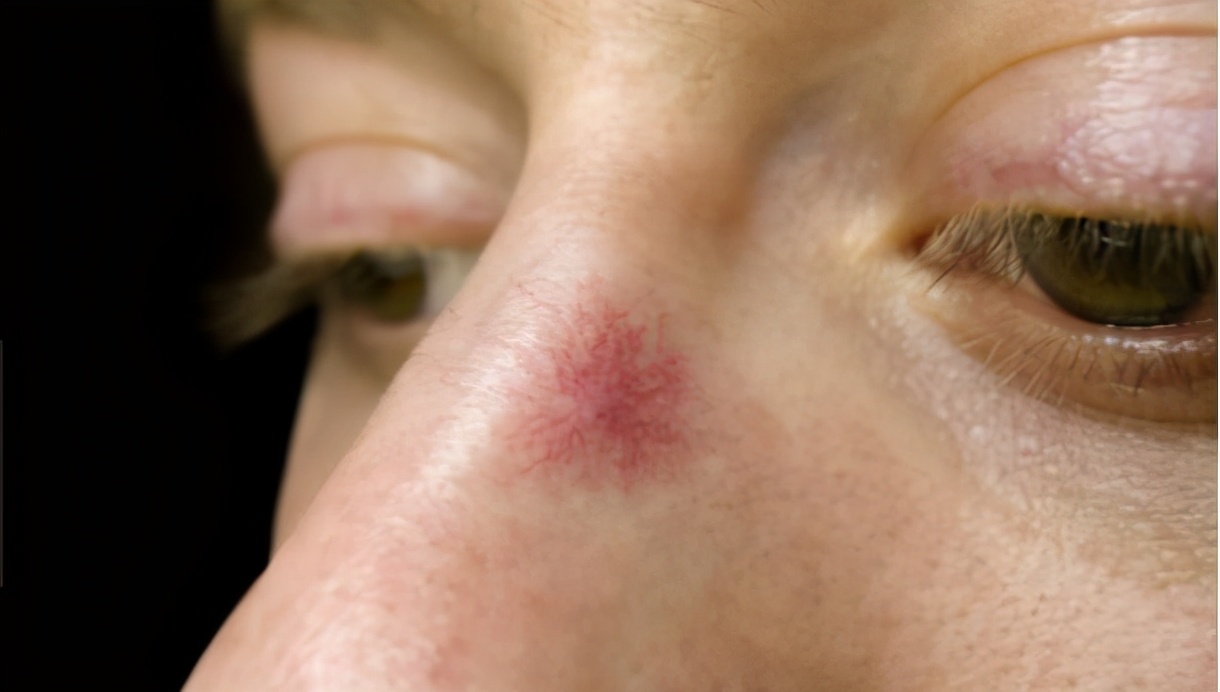 长蜘蛛痣一定就是肝病吗,长蜘蛛痣肝病到哪种程度了