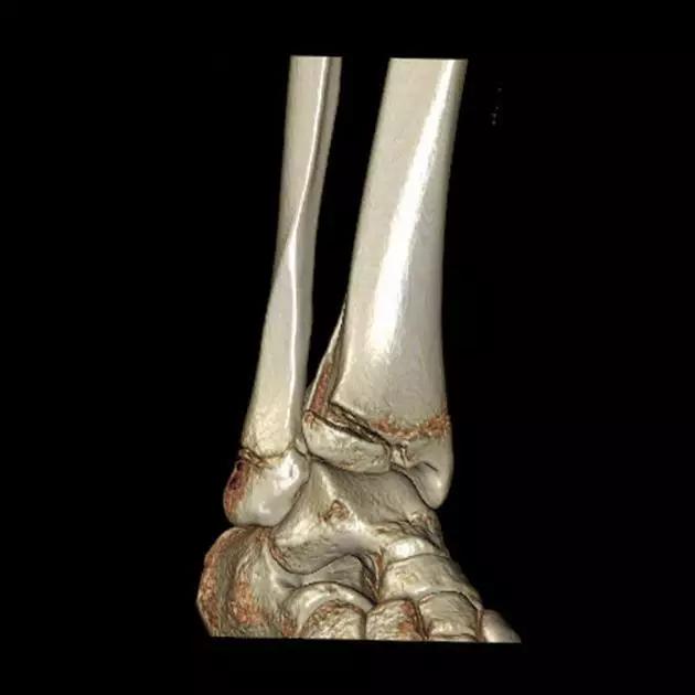 几种严重骨折医学名称,常见的骨折有哪些名称