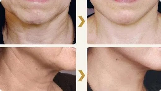 18岁脖子上有颈纹怎么按摩,18岁怎么去颈纹