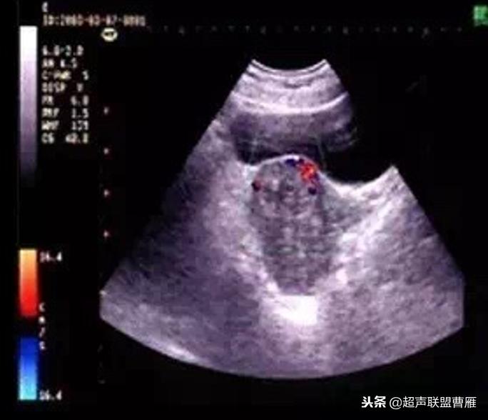 剖宫产疤痕妊娠动画,剖宫产疤痕妊娠的临床分型