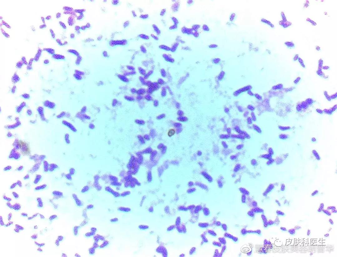 是湿疹或癣医生一眼就能辨出来吗,是不是体癣怎么检查