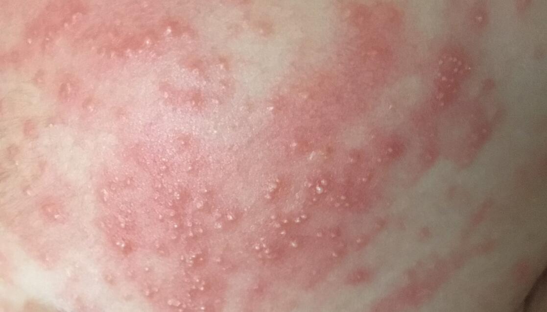 黄水疮冬天发生是怎么回事,冬季黄水疮怎么引起的