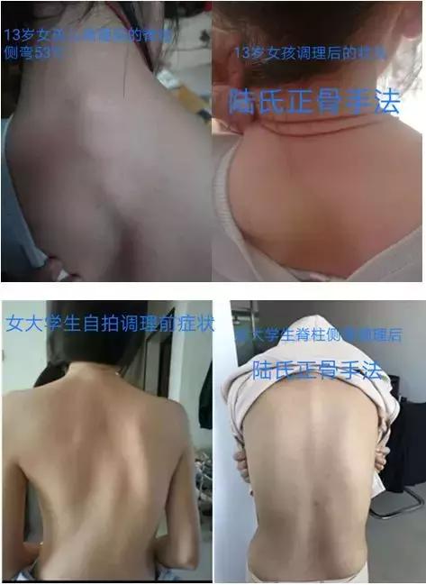 中国陆氏九龙正骨创始人陆玉贵的“正骨一绝”