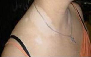 美白产品使用不当竟然导致白癜风,用了美白产品得了白癜风