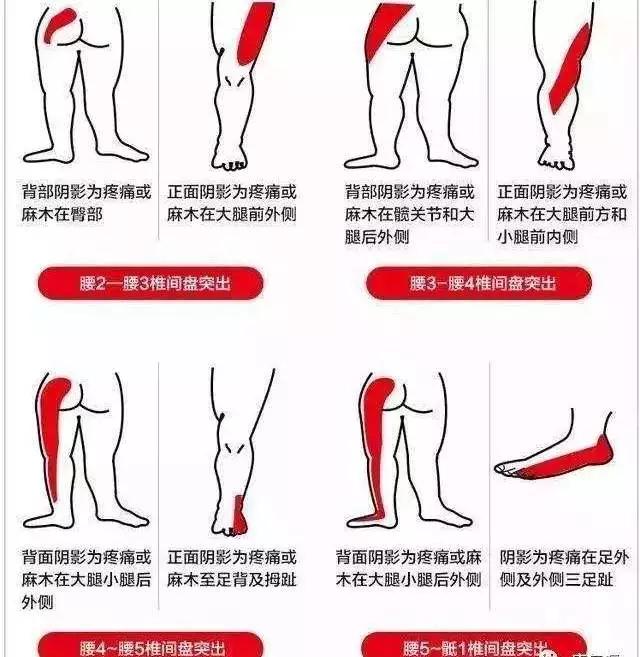 坐骨神经痛锻炼视频,坐骨神经讲解视频
