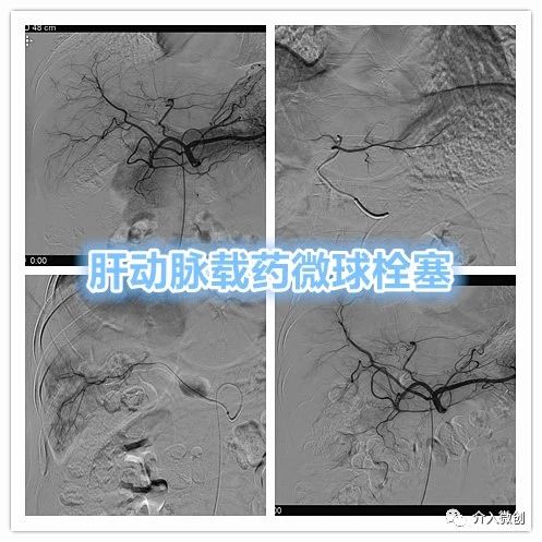 胃癌晚期化疗一次多少钱,胃癌晚期不化疗用靶向药