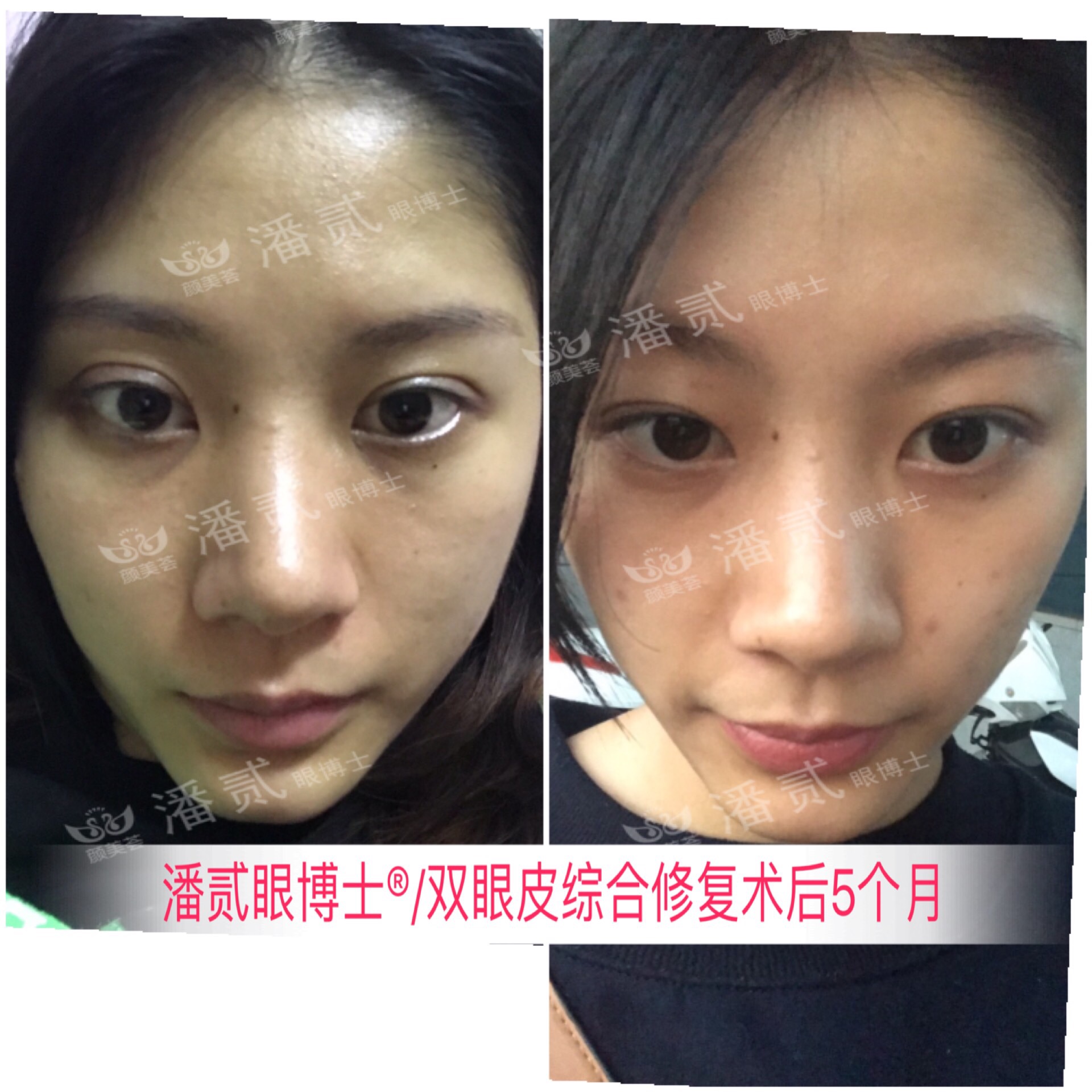 肿眼泡抽脂肪埋线双眼皮效果,肿眼泡割双眼皮长脂肪