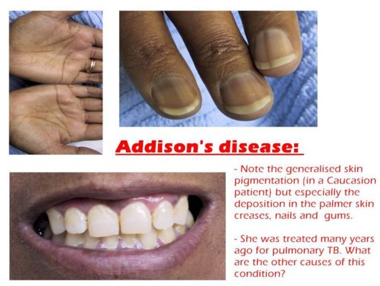 肾上腺皮质激素减退皮肤表现,肾上腺皮质功能减退症诊断标准