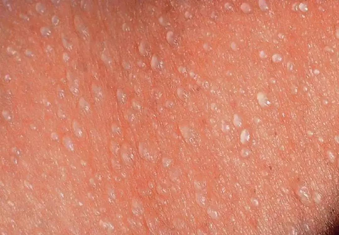 小孩子天气热长痱子怎么办,孩子天热出痱子怎么办