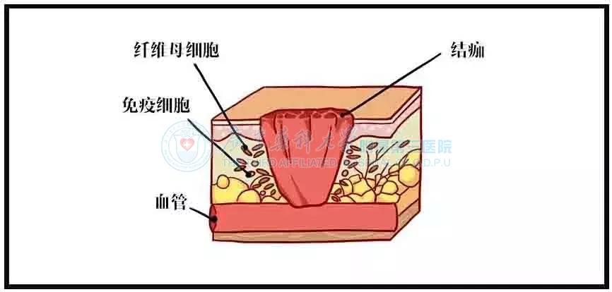 为什么伤好了会留疤,为什么一个小伤口愈合后都会留疤