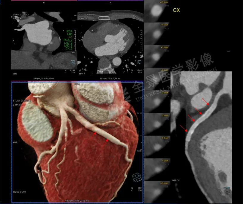 颈部肿块为什么有80%是肿瘤,颈部肿块1年没有变化