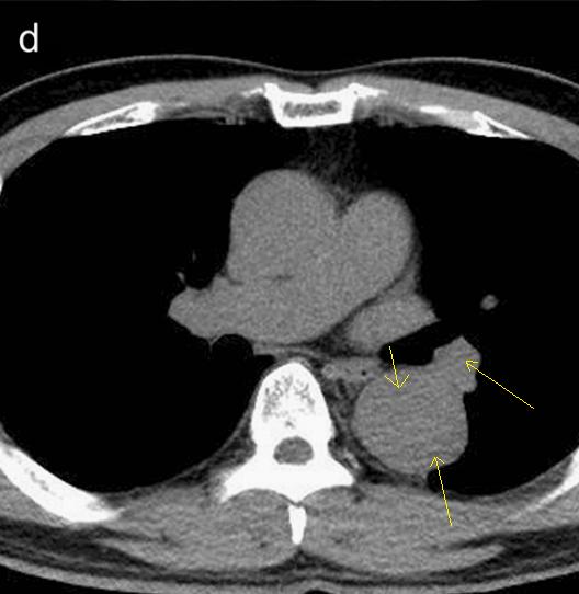 如何监测动脉夹层早期,动脉增强ct能查出主动脉夹层么