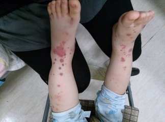 腹型过敏性紫癜治好了注意什么,过敏性紫癜饮食上要注意些什么