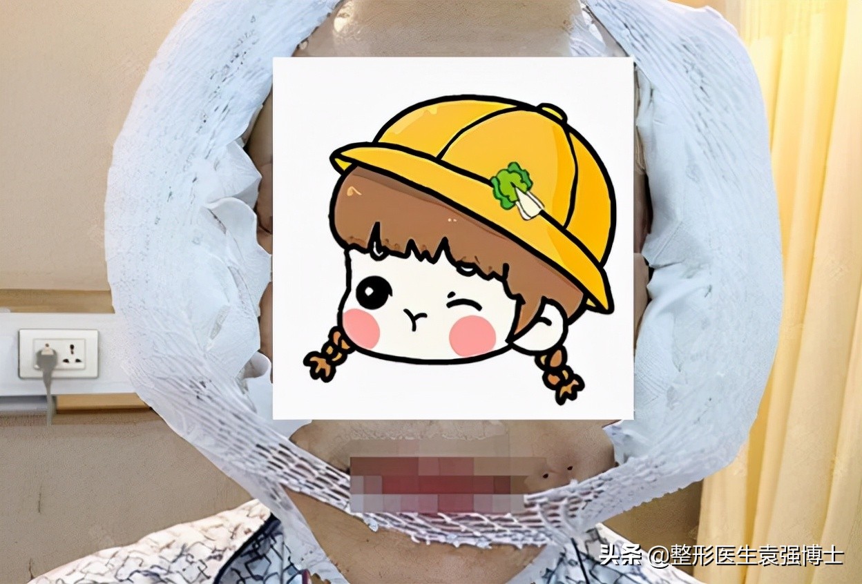 45岁的女人做侧拉皮,48岁做拉皮手术亲身经历