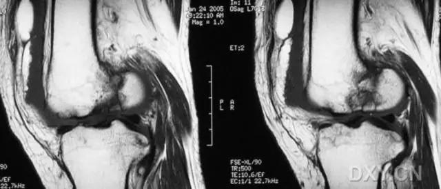 所有骨折都叫什么名字,骨折的名称有哪些