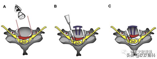 acaf手术适应脊髓型颈椎病吗,acaf术后康复方法
