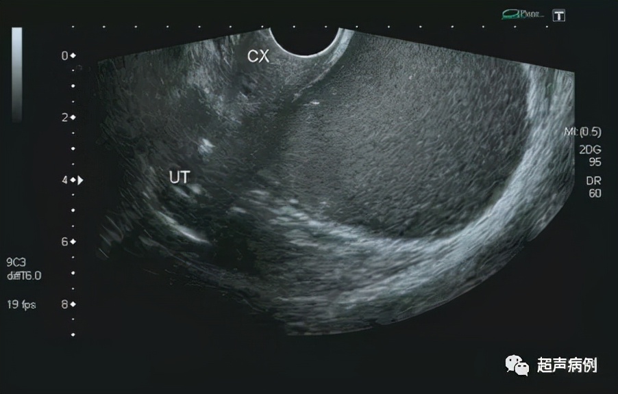 臀部包块超声检查,盆腔囊性包块10公分肚子剧痛