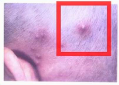 宝宝热出痱子婆婆说烂胎盘,高温天气宝宝热痱子怎么治好得快