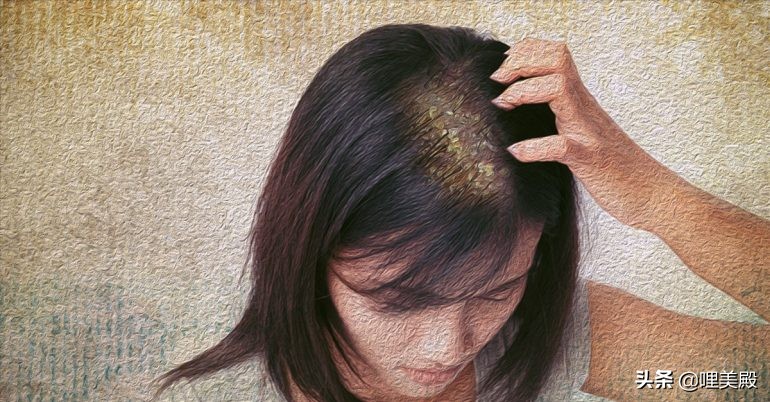 头皮屑会引起白发吗,雄激素性脱发会导致头皮屑多吗