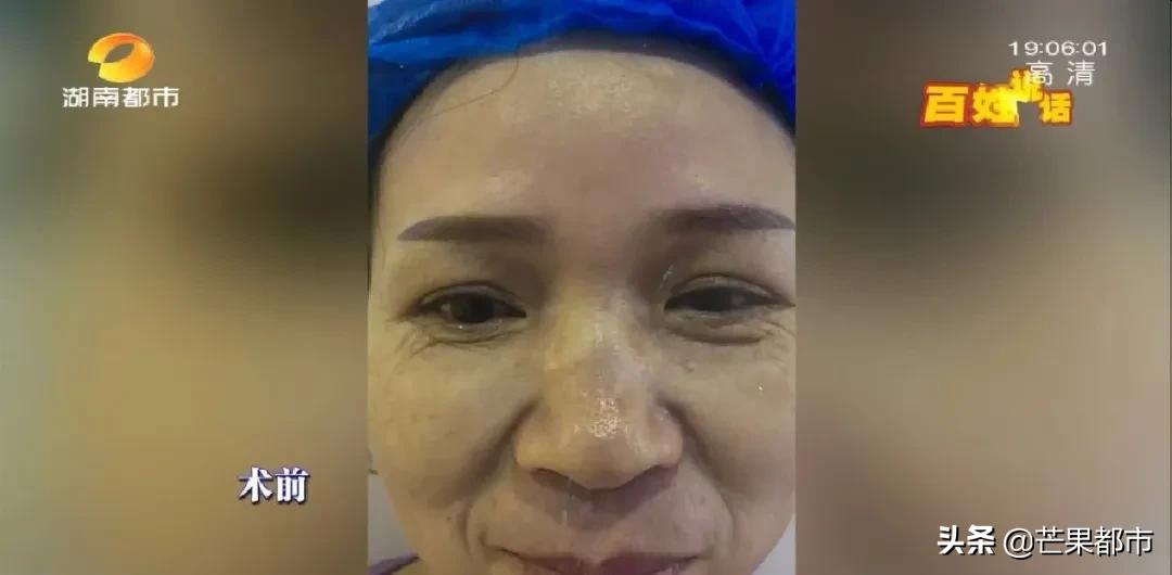 医生推荐去除法令纹,长沙法令纹除皱