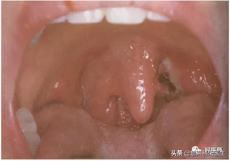 咽喉疾病科普知识,咽喉疾病动画科普视频