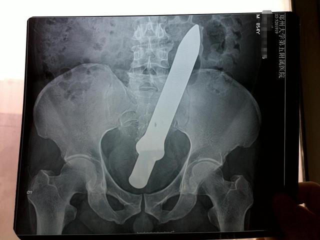 活久见！兴化男子为治便秘将黄鳝塞进直肠，黄鳝咬穿肠子进入腹腔