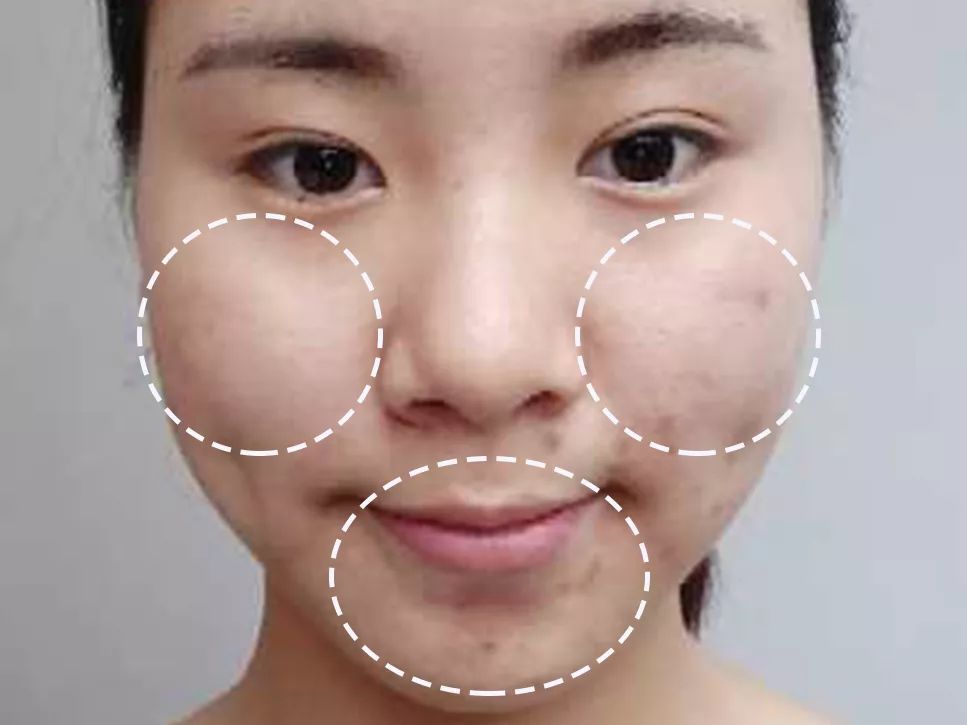 求改善痘痘真实办法,想改变脸上痘痘