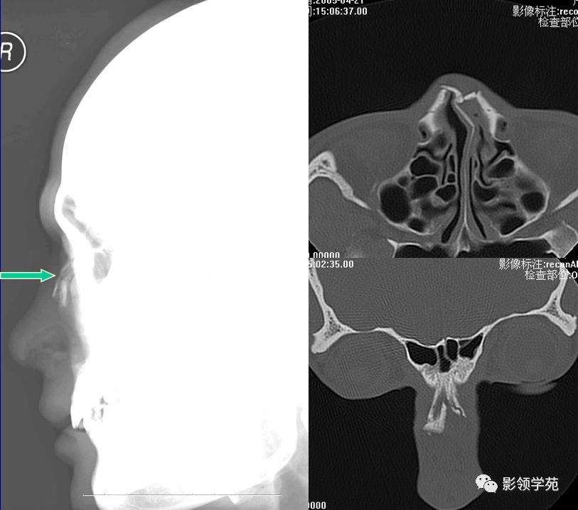 鼻骨影像学解剖,鼻骨解剖及骨折影像学诊断