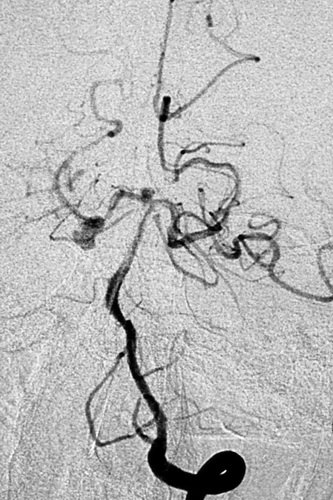 颅内巨大动脉瘤首选治疗技术,大脑中动脉动脉瘤闭塞的介入治疗