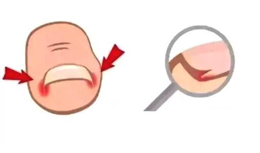 甲沟炎的症状及治疗方法,甲沟炎是什么症状怎样治疗