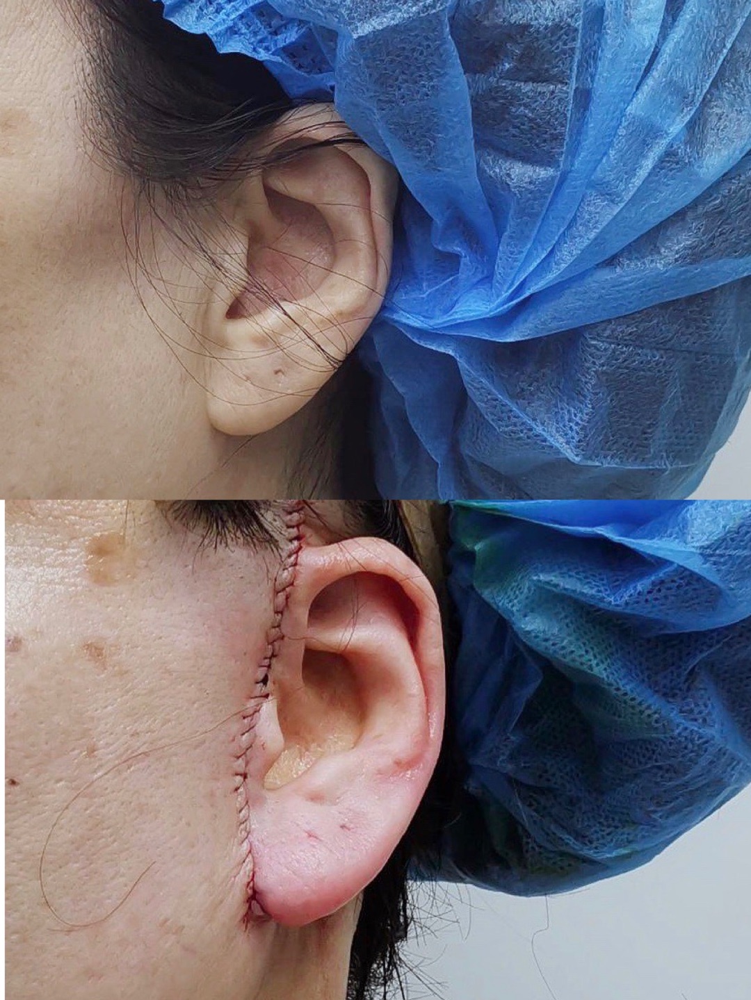 小切口拉皮手术后多久可以敷面膜,小拉皮手术后几天拆线