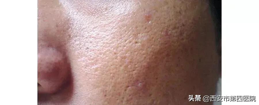 脸上毛孔大靠什么医美解决,毛孔粗大如何正确护肤