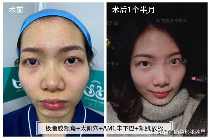 颧骨突出显凶怎么改善,脸凹显凶