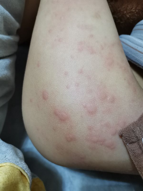 宝宝身上起疙瘩像蚊子咬一样还痒,宝宝身上长疙瘩像蚊虫叮咬怎么办