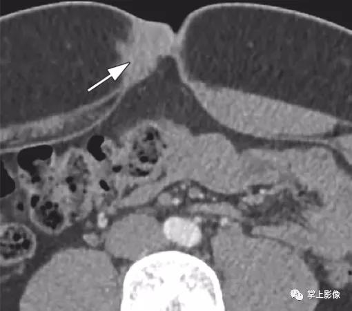 腹壁病变诊断思路,腹部影像诊断读片入门视频