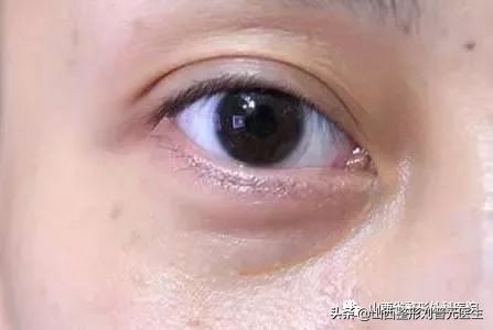 46岁做眼袋还需要做卧蚕吗,现在都把眼袋叫卧蚕了吗