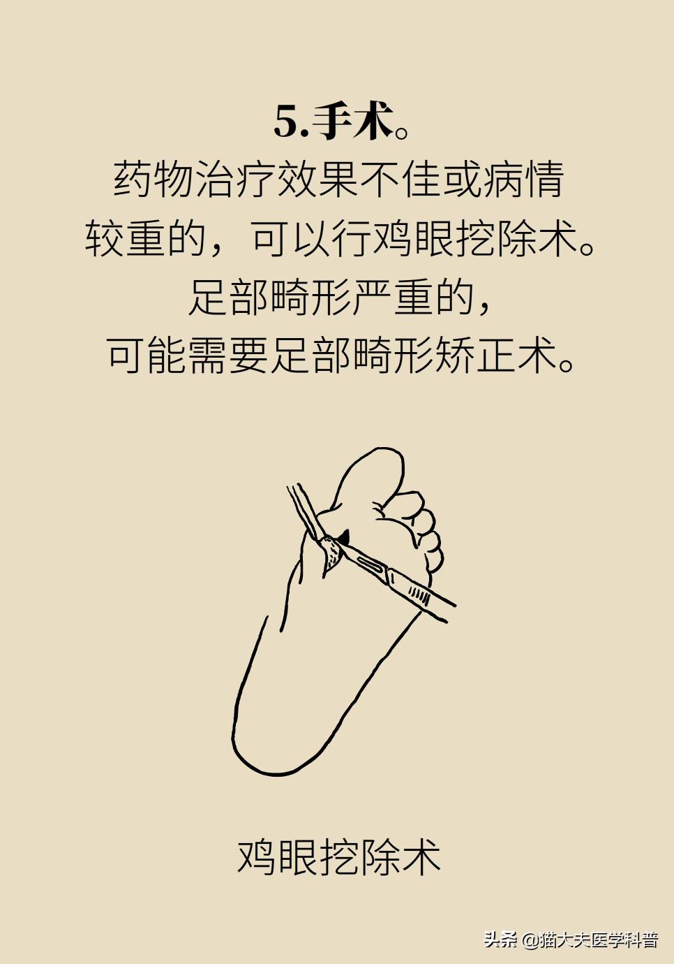 鸡眼好了长了一层老茧,鸡眼与老茧的区别图片