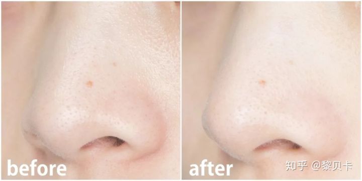 黑头去除神器排行榜,黑头粉刺清除强力推荐网红产品